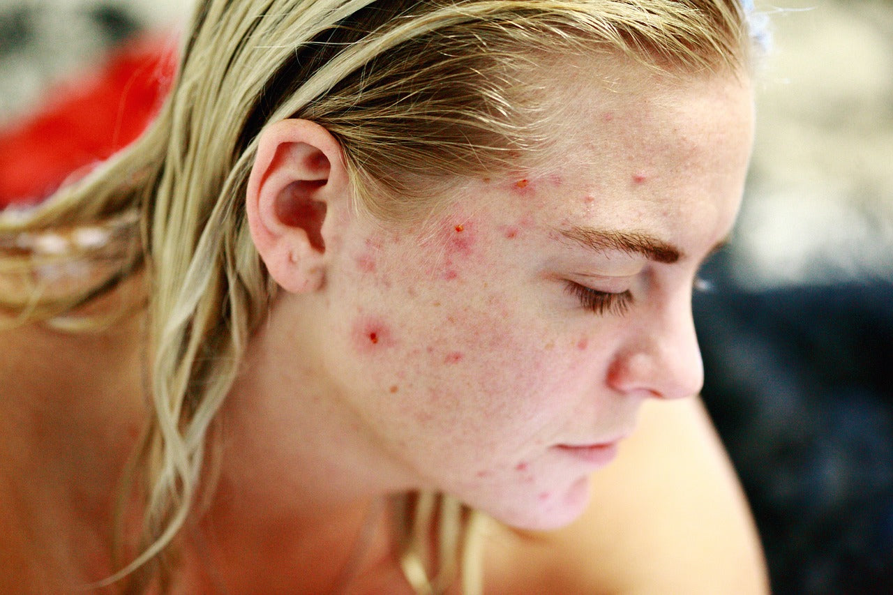 Acne From Whey Protein